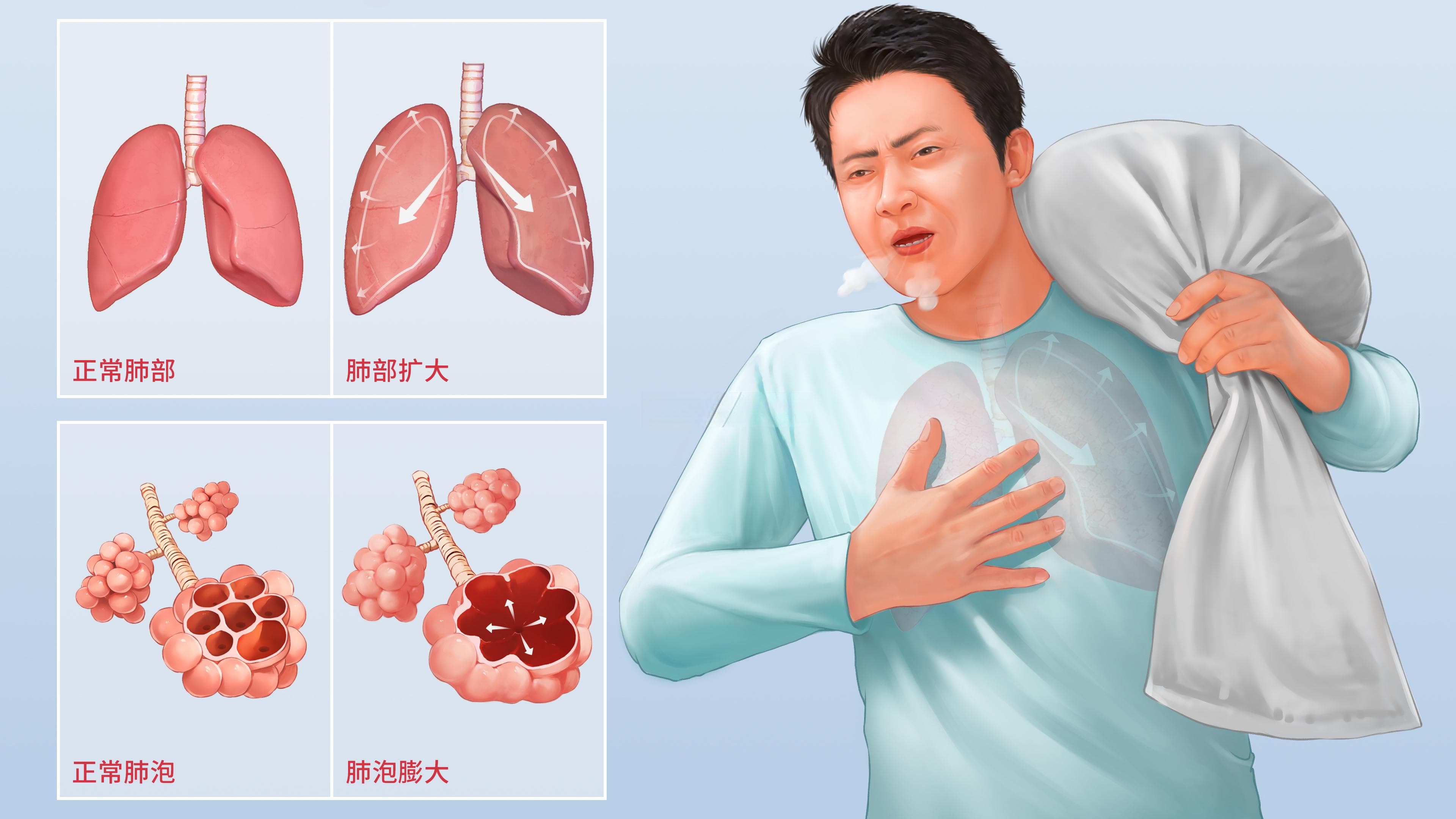 肺气肿：症状、诊断与治疗全解析