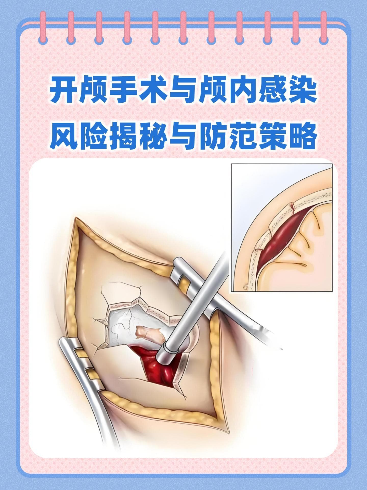 揭秘开颅手术：十个患者九个怕颅内感染