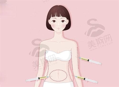 吸脂术后需要穿多久的塑身衣？不同部位和时间段穿塑身衣时长有所不同