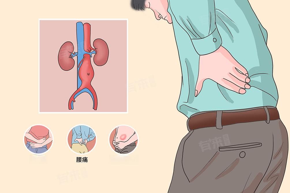 腹主动脉瘤手术指征