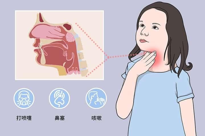 急性上呼吸道感染：预防、识别与治疗