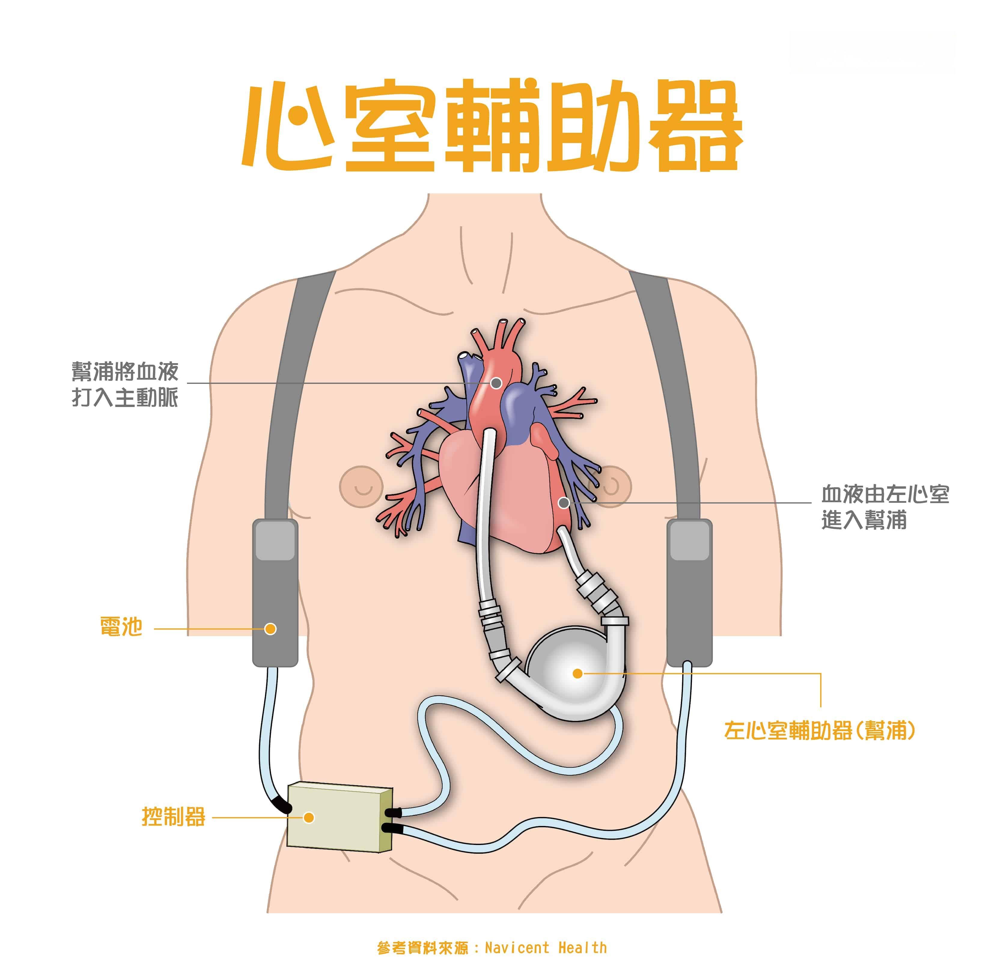 心脏手术全解析：从冠状动脉到心律调节器