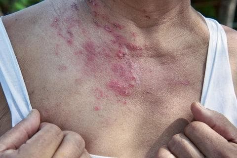 带状疱疹：症状、原因和治疗