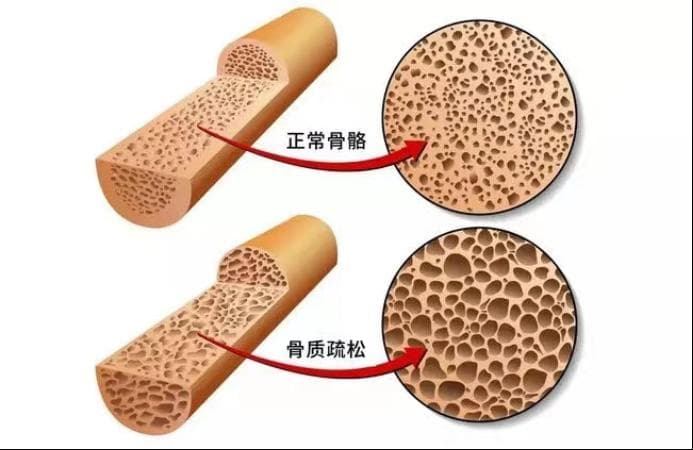 【微科普】骨标志物筛查，预警骨质疏松症