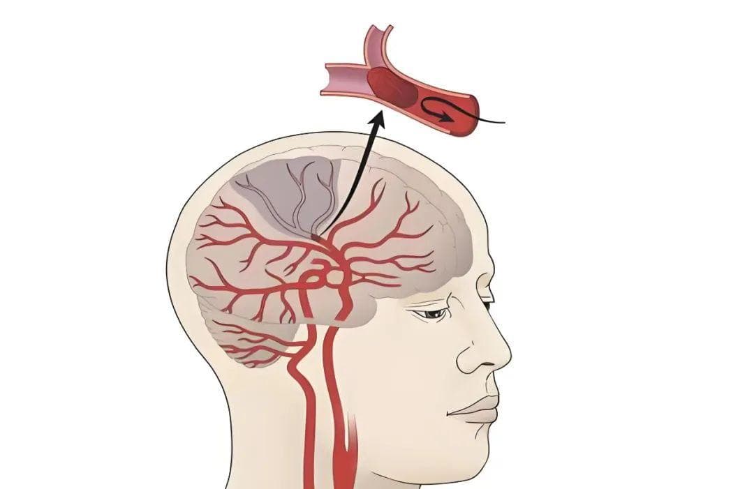 健康科普丨腔隙性脑梗死，需要治疗吗？