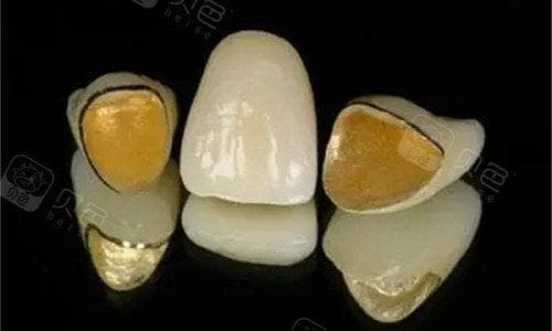 烤瓷牙材料种类与特性：如何选择适合您的修复方案