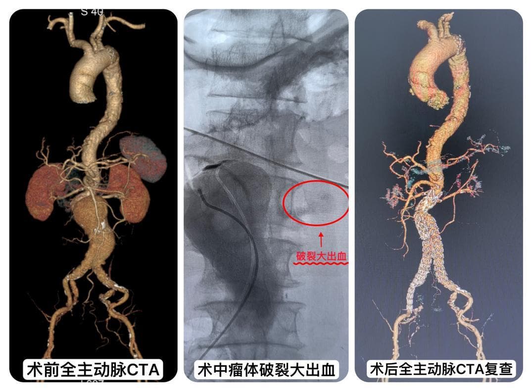 老人突发腹主动脉瘤破裂，多学科团队协作破解危机