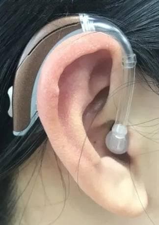 耳朵突然闷堵、耳鸣，小心突发性耳聋！