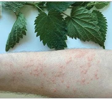 低剂量IL-2疗法：慢性荨麻疹治疗的新突破