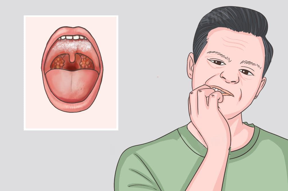 口腔里面有白色的黏膜怎么办