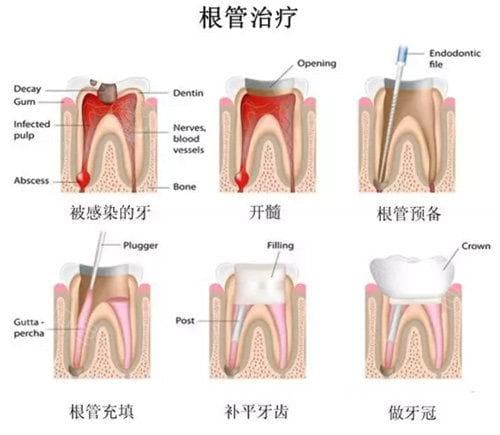 揭开牙科治疗的神秘面纱——牙神经要抽几次才干净？1-3次！