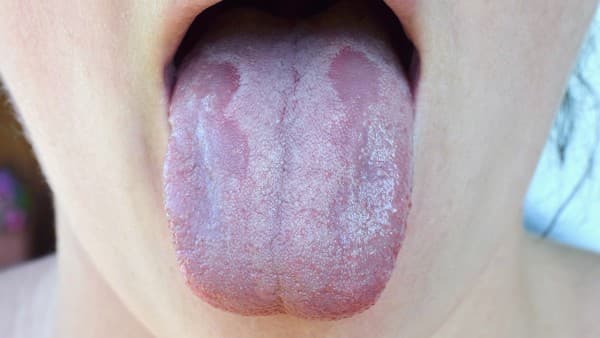 痛风急性发作有哪些特效药？痛风初期有哪些症状表现？