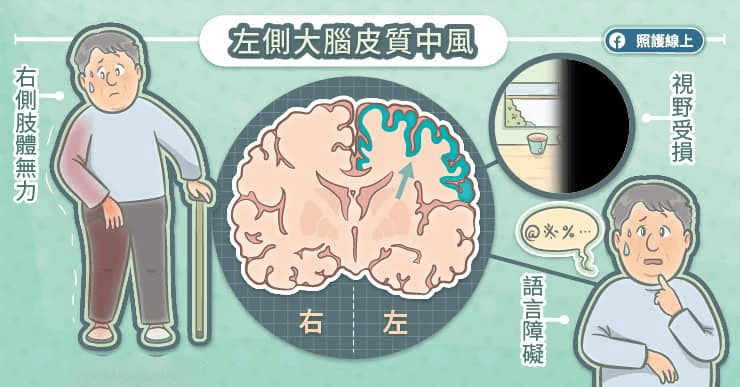 提高警惕！不只是手脚无力，这些症状都可能是中风！