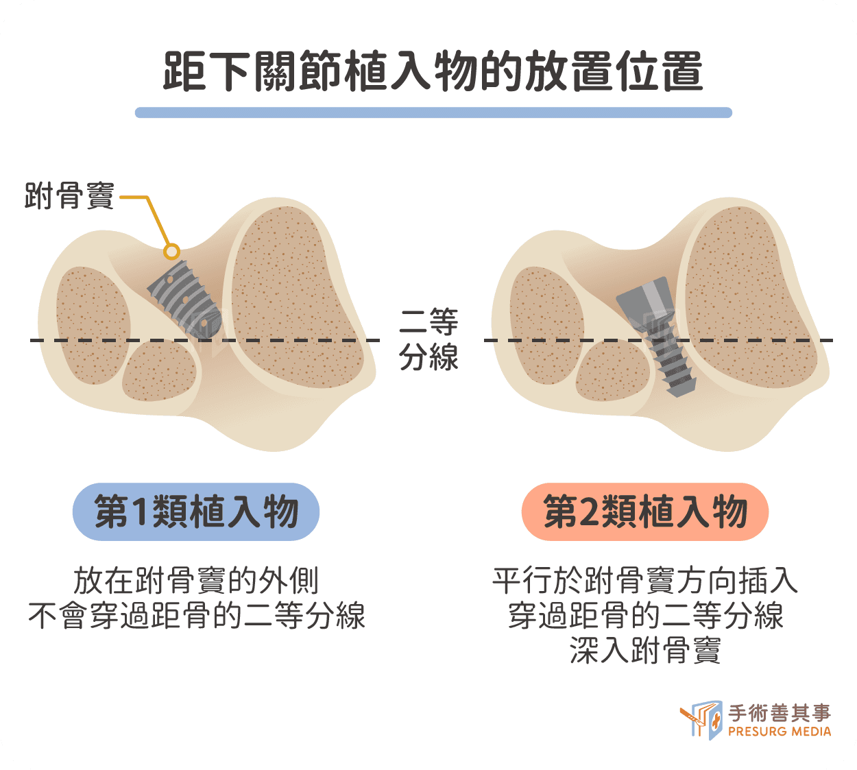 儿童扁平足怎么办？矫正儿童足弓塌陷及足外翻：距下关节限制术