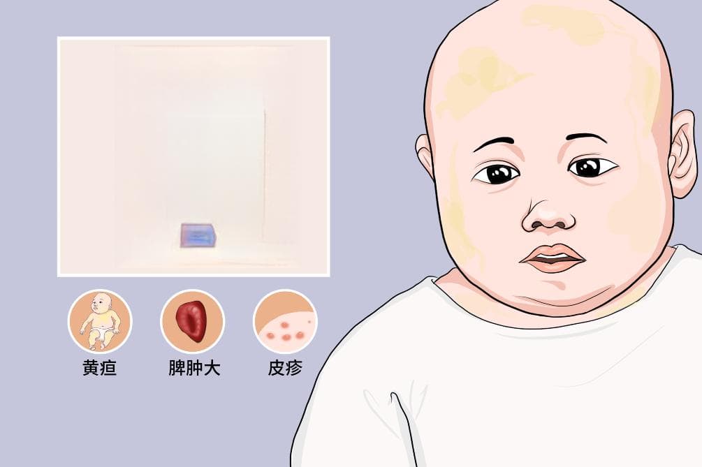 巨细胞病毒感染