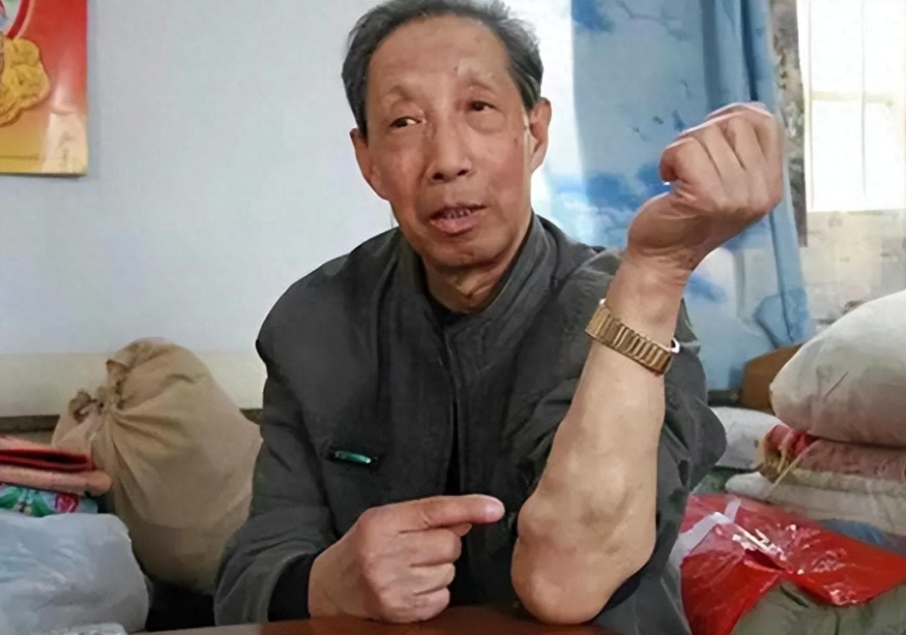 身上长了“脂肪瘤”要不要手术切了？骨科医生：你需要注意这3点