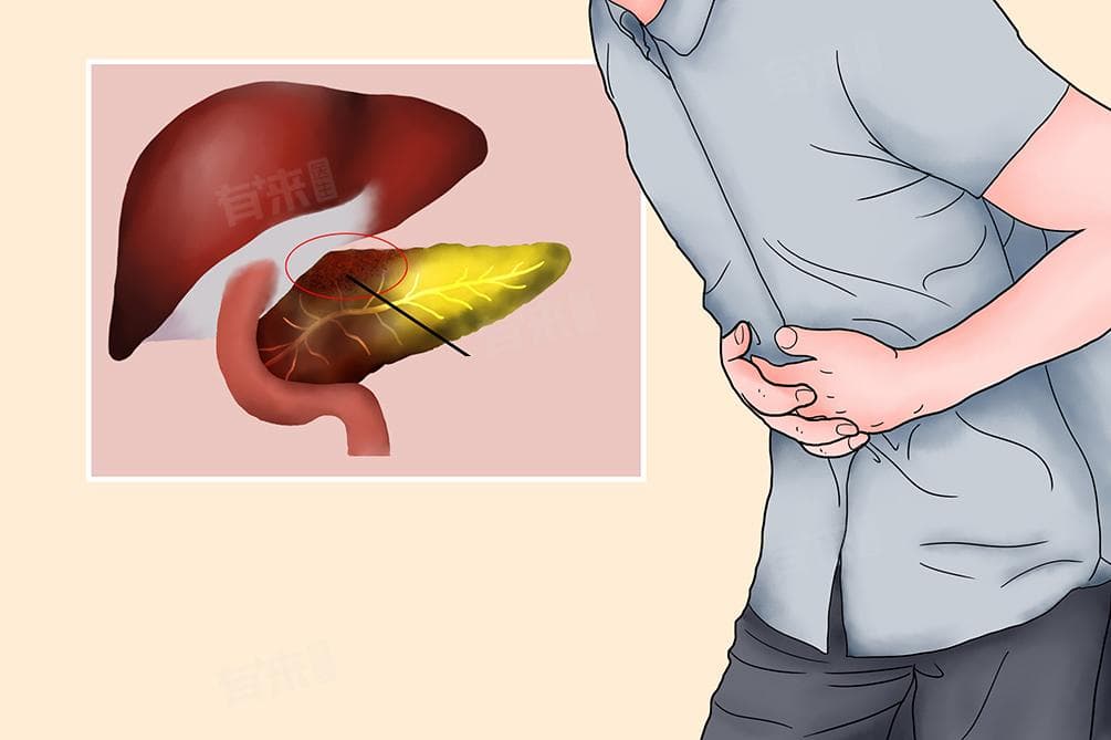 胰腺炎的原因及预防措施