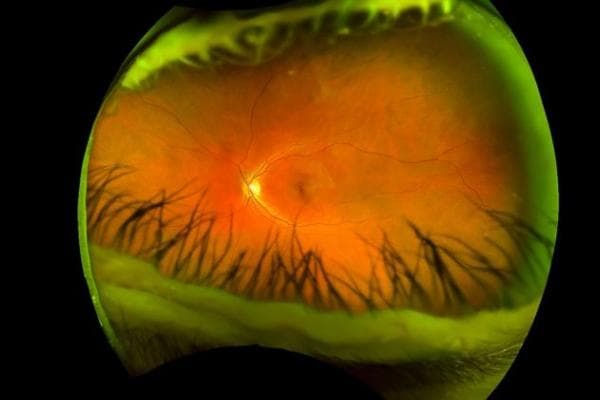 当兵眼睛视力要求多少度？视力矫正的2个常见方式