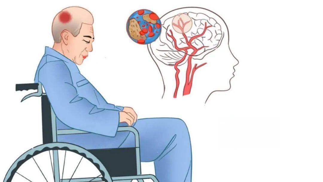 “醒脑开窍针刺法”治疗中风病：奉贤区中医医院特色诊疗技术