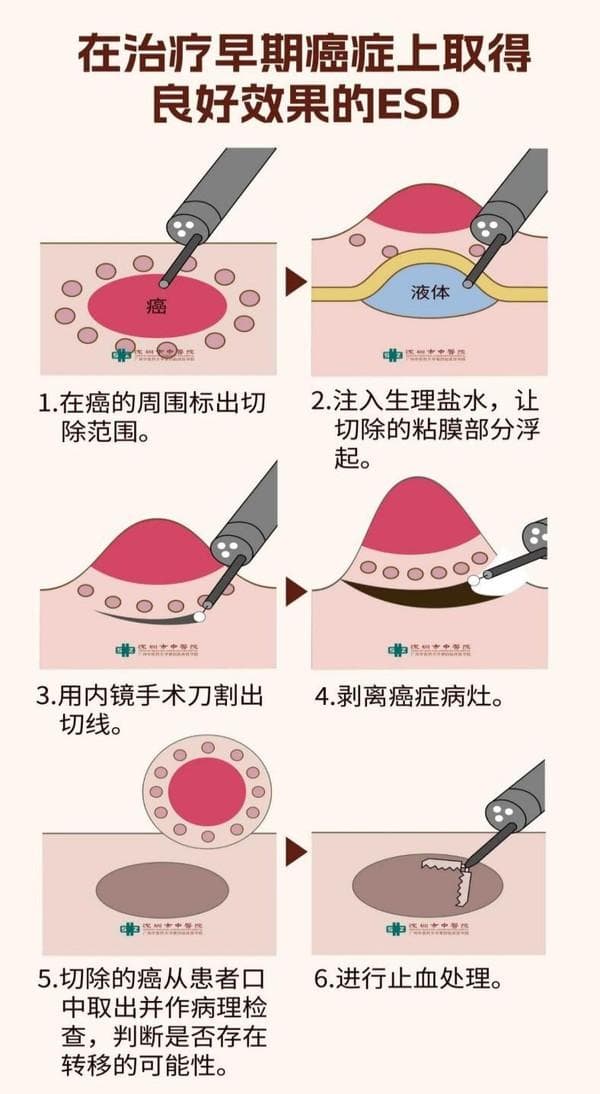 池州市人民医院熟练开展没有体表切口的胃癌手术——内镜黏膜下剥离术（ESD）