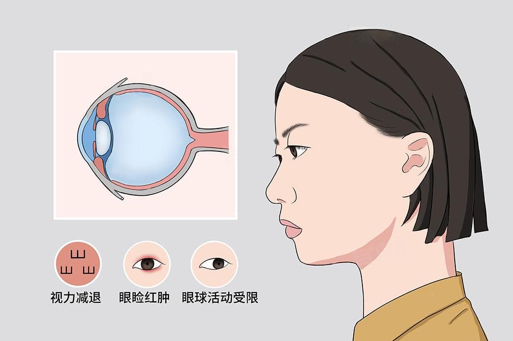 眼球突出矫正手术：原理、方法与注意事项
