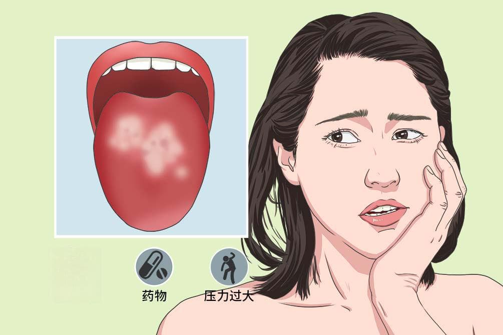 口腔扁平苔藓：病因、症状、诊断与治疗全解析