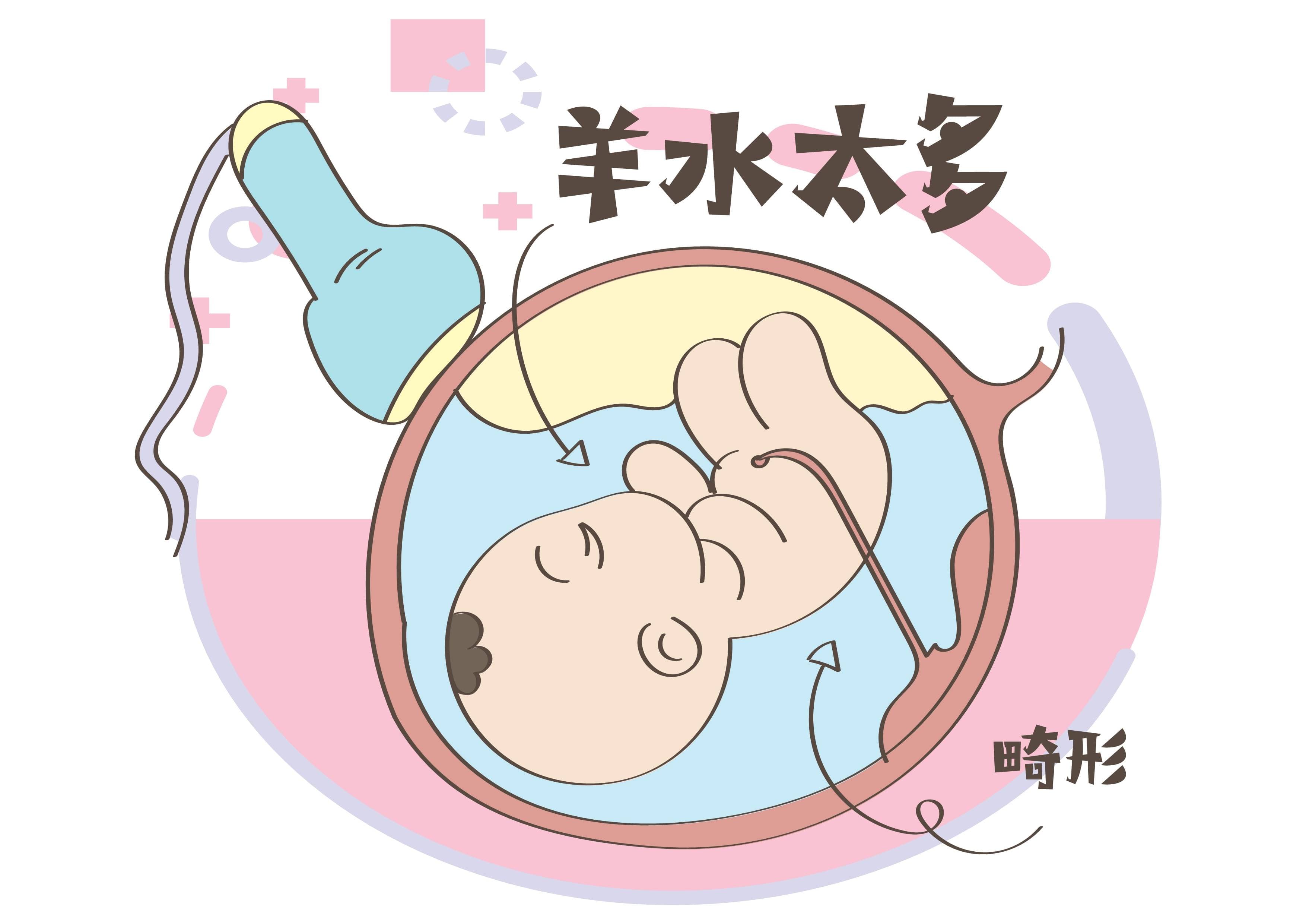 兰州天伦孕产知识：怀孕羊水过多对胎儿有什么影响？如何预防？