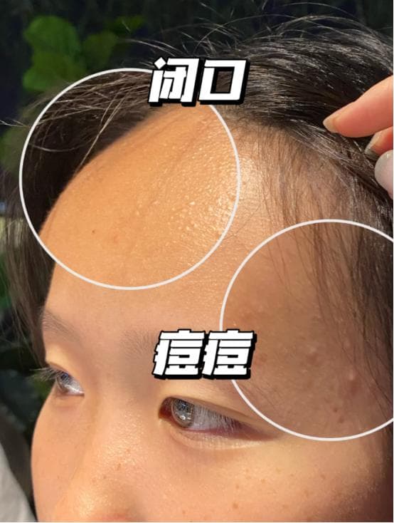 水杨酸棉片正确使用方法，用对了才能解决痘痘问题，不让青春留遗憾