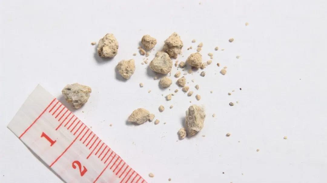 【疾病科普】多喝水不能排掉所有肾结石！一次说清10个误解