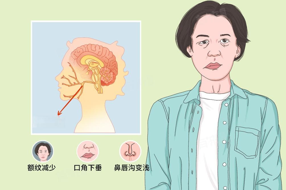 面神经炎怎么治疗好得快