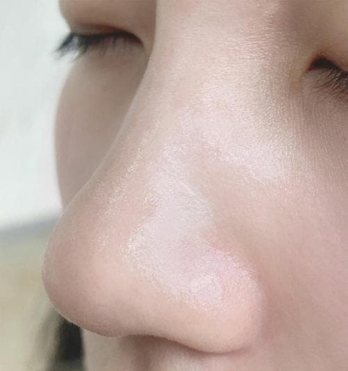 有效去除黑头的方法（掌握正确去黑头的关键技巧）
