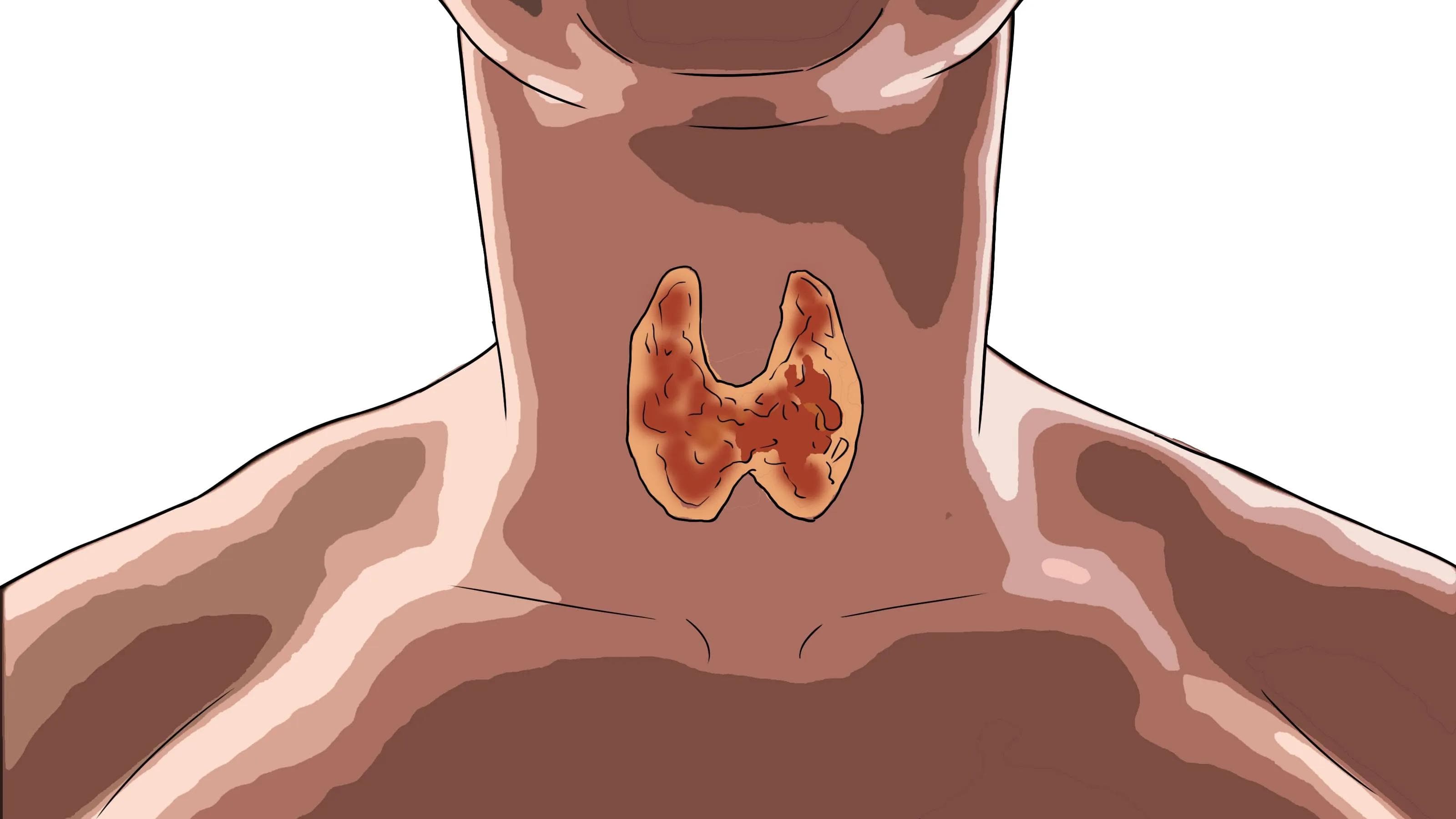 甲状腺核素显像