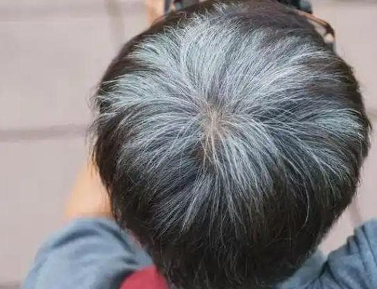 年纪轻轻却满头白发？医生提醒：缺乏这3种营养素！