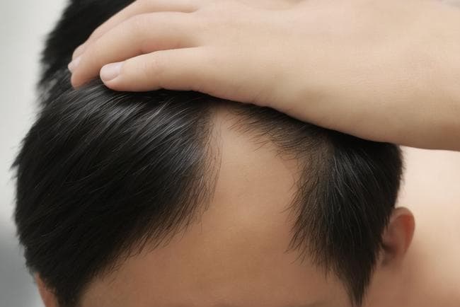 如何判断自己是否患有雄激素性脱发