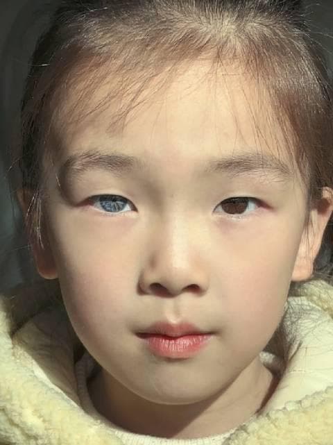 医学科普：什么是异瞳？