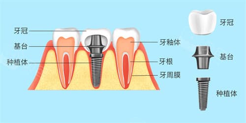 详解种植牙种类与款式：从形态到材料的全面解析