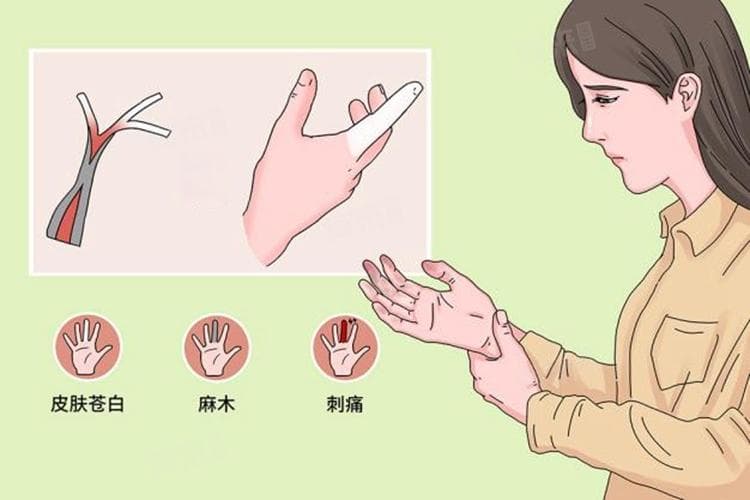 雷诺氏综合征的临床表现