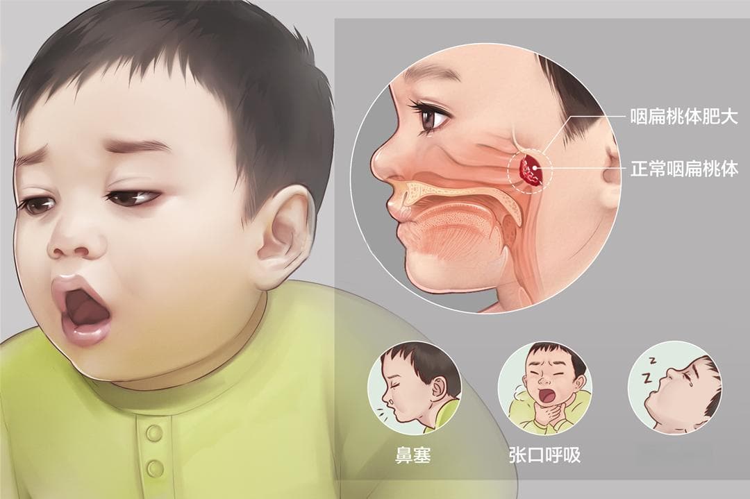 儿童扁桃体炎的饮食调理指南