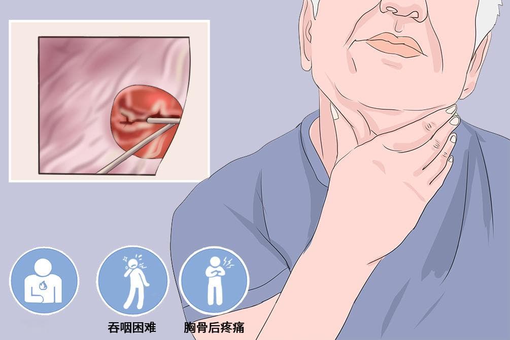 食管溃疡：病因、症状、诊断与治疗全解析