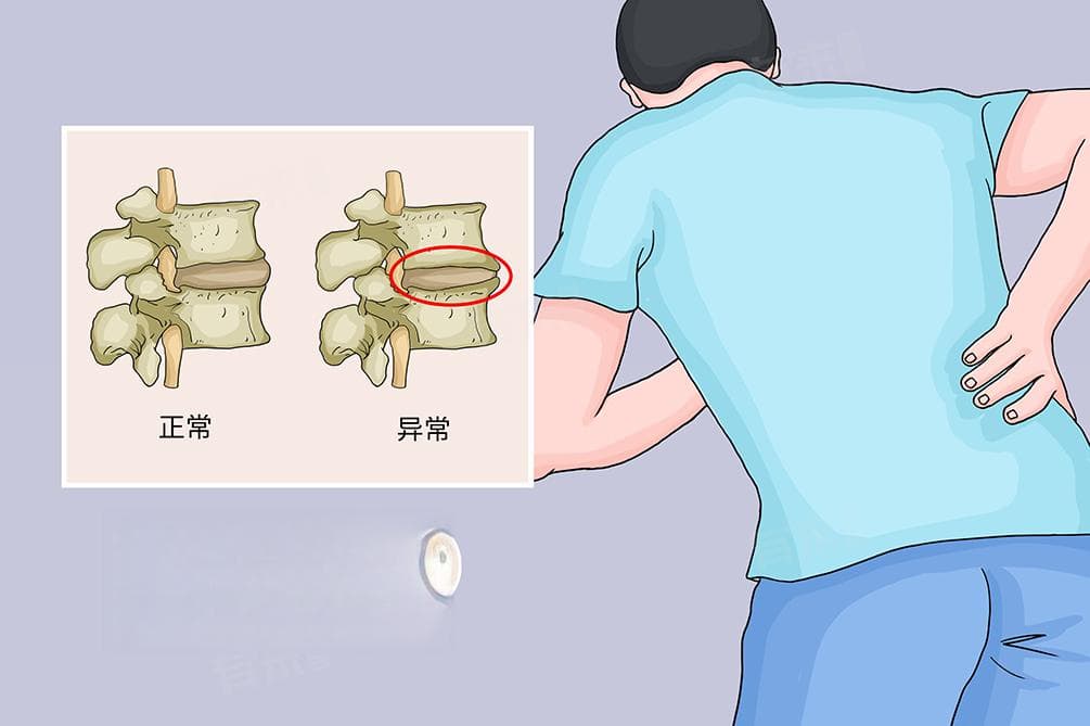 腰椎骨质增生的症状及检查方法