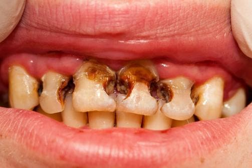 氟化物：孩子牙齿健康的隐形守护者