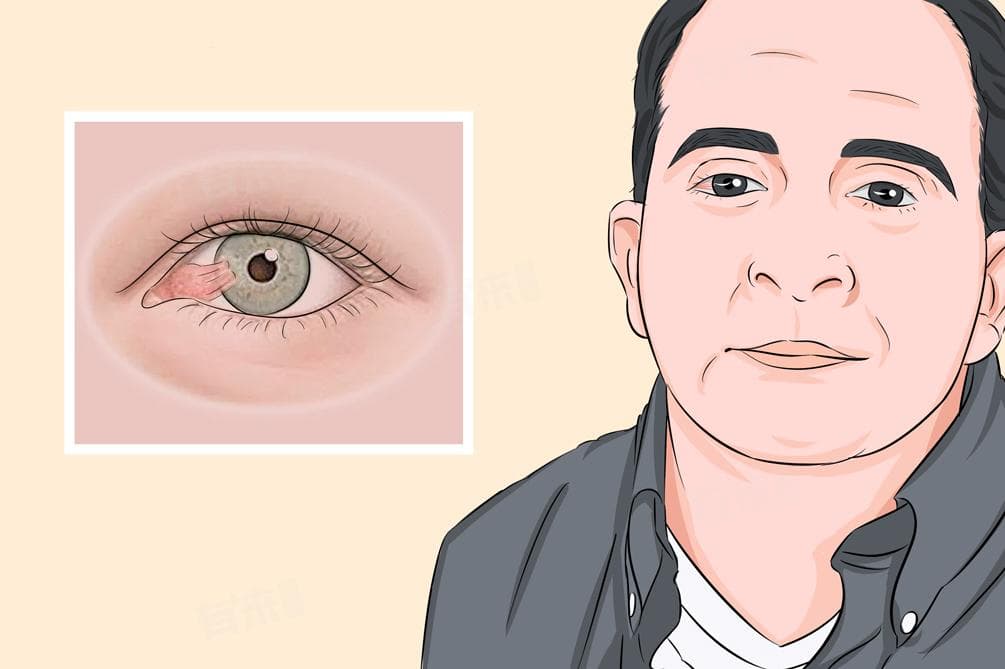白眼球上的白色凸起物：可能的原因及应对方法