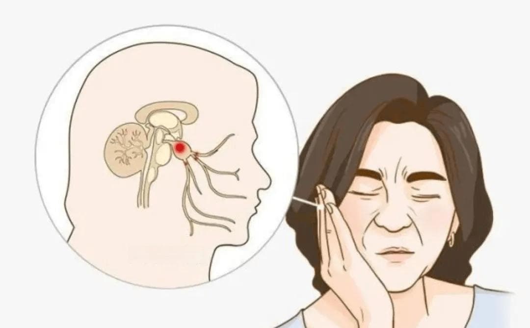 根治三叉神经痛的理想之选--显微血管减压术