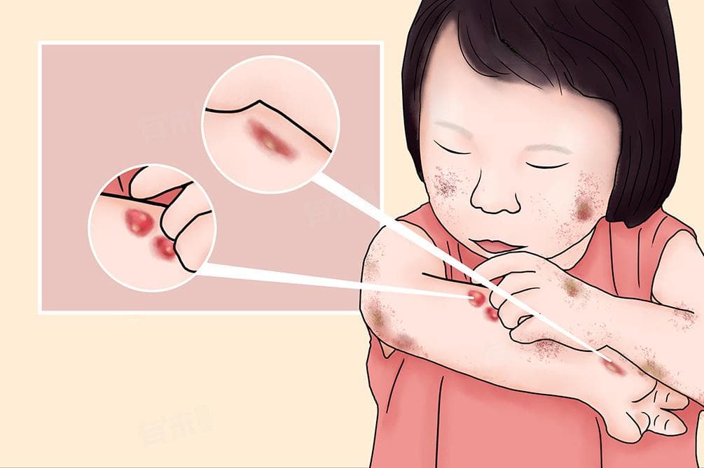 脓疮是什么意思