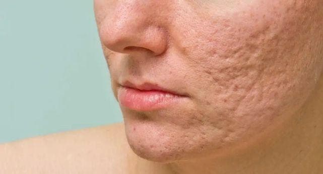 外泌体治疗痤疮疤痕临床研究：25例短期随访结果
