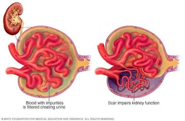 局灶节段性肾小球硬化（FSGS）：症状、病因及并发症全解析