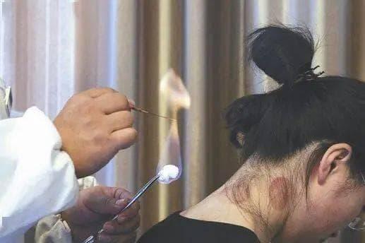 火针疗法：传统中医的特色针灸疗法