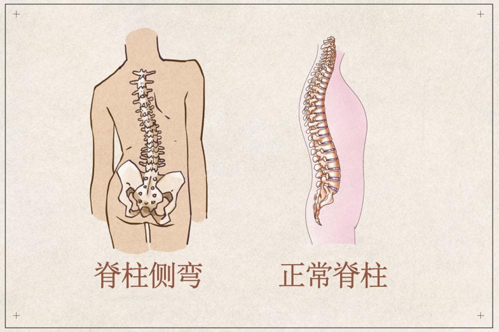 高低肩、长短脚…警惕孩子脊柱侧弯！