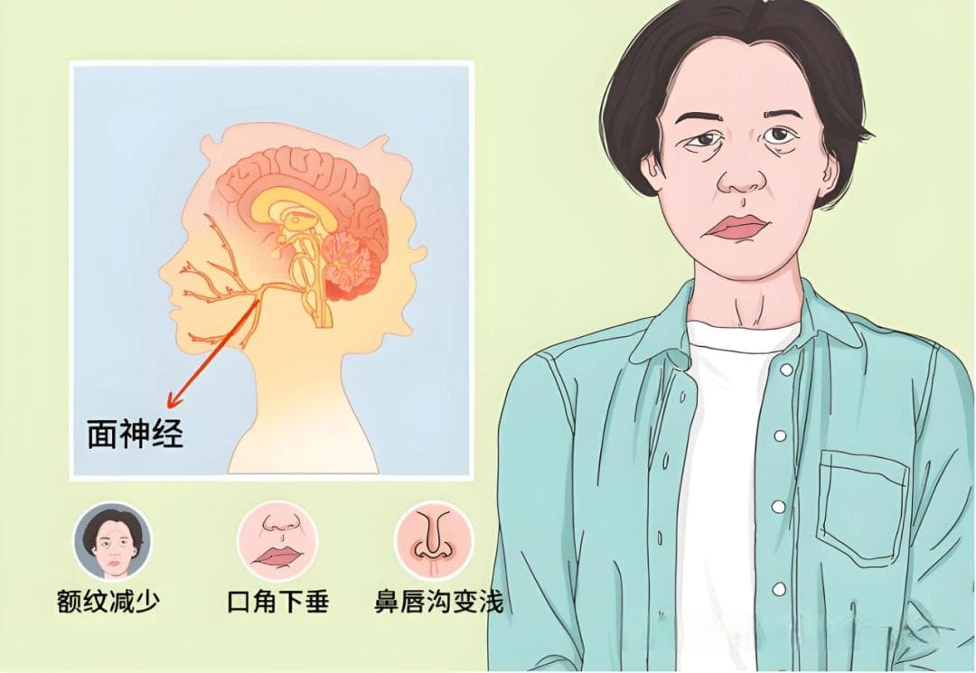 一觉醒来嘴歪了，别慌！这 8 个简单动作来帮你