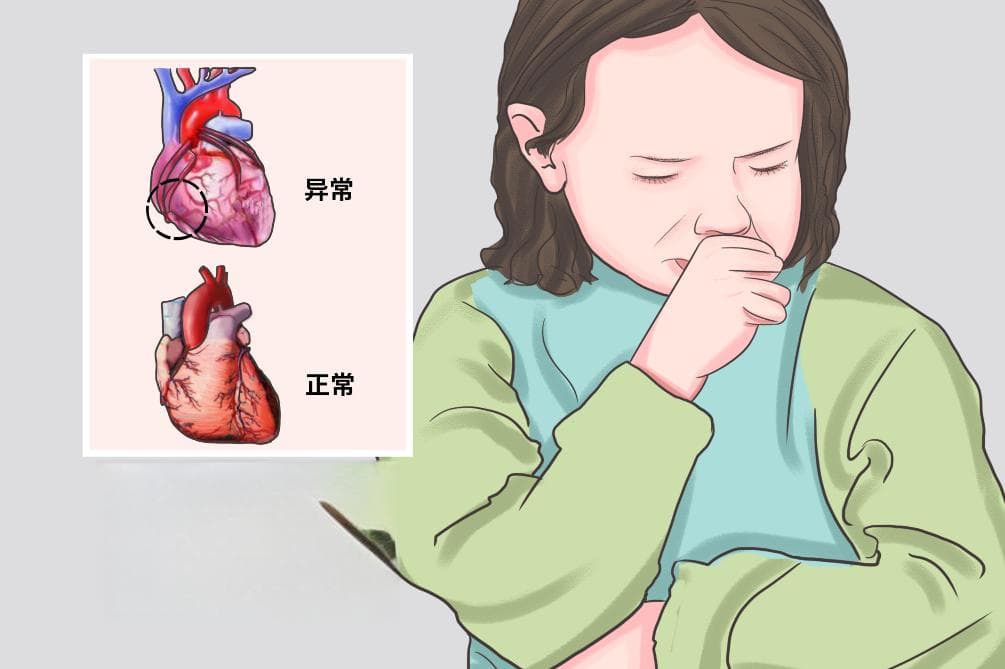 冠状动脉异位起源